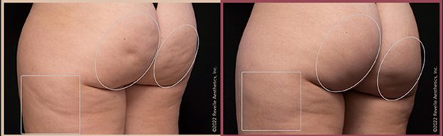 Before and after Aveli treatment results on woman's buttocks