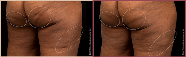 Before and after Aveli treatment results on woman's buttocks