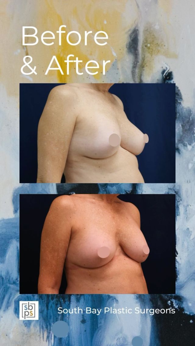 Patients may choose to revisit their implants for a variety of reasons. Although she wasn’t having any issues, this patient was looking to correct some asymmetry that had developed over time.⁠
⁠
@drwhitneyburrell removed her old implants and replaced them with 335cc on the right and 270cc on the left. In order to keep the skin from stretching over time, Dr. Burrell also placed Galaflex mesh to create an internal bra @galaflexbybd ⁠
⁠
Are you interested in secondary breast surgery? Click the link in bio or call us at 310-784-0644 to schedule today!⁠
⁠
#southbayplasticsurgeons #sbps #secondarybreastsurgery⁠
⁠