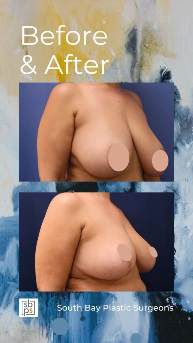 This 55-year old patient was diagnosed with breast cancer in her left breast and met with one of our board-certified plastic surgeons to discuss reconstructive surgery. She underwent a lumpectomy to obtain clean margins and @drwhitneyburrell performed an oncoplastic reduction. We were able to remove volume from both breasts giving her relief of her symptoms and a more symmetrical and perky breast shape.⁠
⁠
This patient is thrilled with her results!⁠
⁠
Unedited photos linked in bio. All photos posted with patient permission.⁠
⁠
Call us at 310-784-0644 to schedule a consultation today!⁠
⁠
#southbayplasticsurgeons #sbps #oncoplasticreduction⁠
⁠
⁠