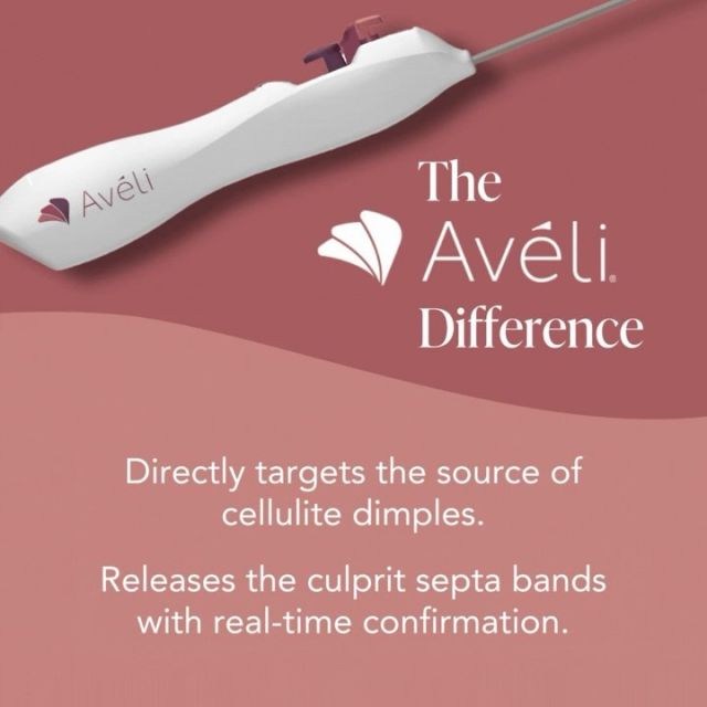 Septa bands cause the bothersome cellulite dimples – and here’s where Avéli® comes to the rescue. ⁠
⁠
During the in-office procedure, the culprit septa bands will be released, confirming their release in real-time, for results visible quickly with minimal downtime.⁠
⁠
Your Avéli treatment is also completely customized to you. We’ll discuss your desired results, mark your areas of concern, and align on a treatment plan that meets your needs. Get started today by contacting us to schedule your consultation.⁠
⁠
📞(310) 784-0670 �📧info@plasticsurgerysource.com �📍Torrance, Ca �www.plasticsurgerysource.com⁠
⁠
⁠
For full safety information visit MyAveli.com/IFU. ⁠
⁠
#Aveli #MyAveli #Cellulite #CelluliteReduction #CelluliteTreatment #NoMoreNonsense⁠