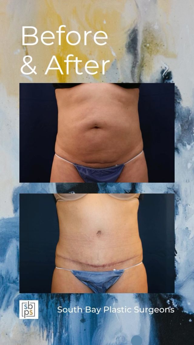 This 41-year old patient wanted to improve the appearance of her abdomen. After pregnancy, she was unhappy with the laxity in her abdominal muscles and excess skin left behind. She consulted with @drnewmanplasticsurgery, one of our board-certified plastic surgeons, and had an abdominoplasty (AKA tummy tuck) as well as liposuction to flatten her abdomen and accentuate her shape. This procedure took several inches off her waistline and she is thrilled with her result!⁠
⁠
All photos posted with patient permission.⁠
⁠
Click the link in our bio or call us at 310-784-0644 to schedule your consultation today!⁠
⁠
#southbayplasticsurgeons #sbps #abdominoplasty⁠
⁠