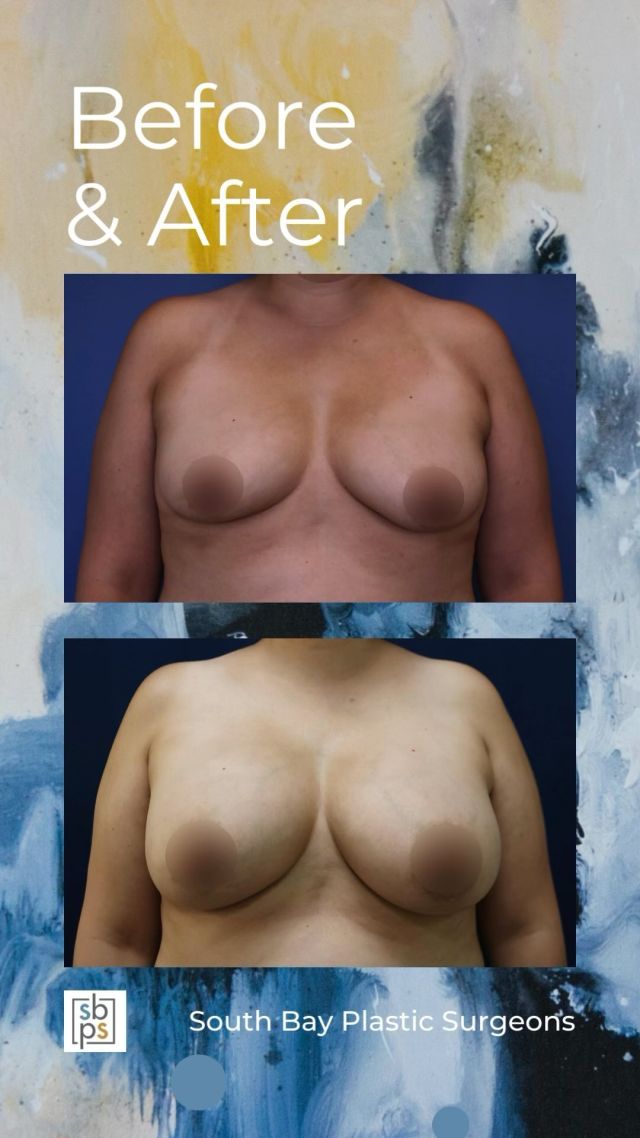 This 40-year-old woman 🧍‍♀️ wanted a fuller and more round breast shape.✨ @lisa_jewell_md_plasticsurgery performed a breast augmentation with @sientrainc 440cc high profile silicone implants placed under the muscle 💪 and through the inframammary (IMF/under the breast) incision. ⁠🪄
⁠
This patient loves her result!⁠🫶
⁠
Unedited photos at the link in bio. All photos posted with patient permission.⁠
⁠
Click the link in our bio or call us at 310-784-0644 to schedule a consultation today!⁠
⁠
#southbayplasticsurgeons #sbps #breastaugmentation⁠
⁠