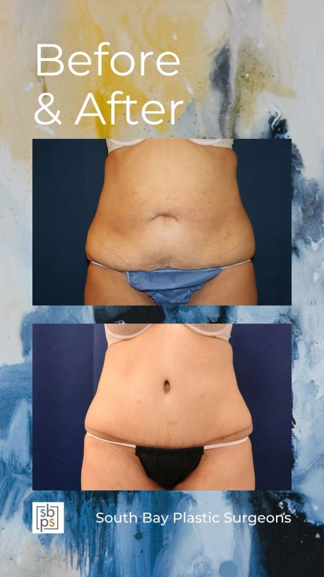 This 45-year old patient wanted to improve the appearance of her abdomen. After weight loss surgery and pregnancy, she was unhappy with the laxity in her abdominal muscles and excess skin left behind. She consulted with @drnewmanplasticsurgery, one of our board-certified plastic surgeons, and had an abdominoplasty (AKA tummy tuck) to flatten her abdomen and accentuate her shape. This procedure took several inches off her waistline and she is thrilled with her result!⁠
⁠
All photos posted with patient permission.⁠
⁠
Click the link in our bio or call us at 310-784-0644 to schedule your consultation today!⁠
⁠
#southbayplasticsurgeons #sbps #abdominoplasty⁠
⁠