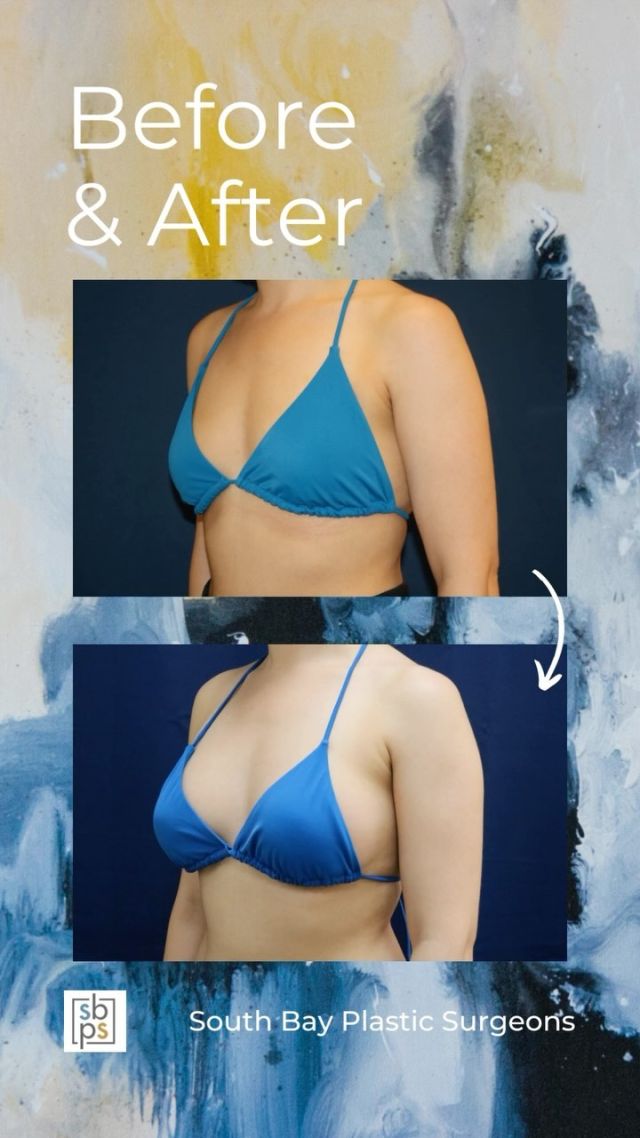 This 32-year-old woman wanted a fuller and more round breast shape. @drnewmanplasticsurgery performed a breast augmentation with @sientrainc 285cc moderate profile silicone implants placed under the muscle and through the inframammary (IMF/under the breast) incision. ⁠
⁠
This patient loves how she looks in a bikini!⁠
⁠
Unedited photos at the link in bio. All photos posted with patient permission.⁠
⁠
Click the link in our bio or call us at 310-784-0644 to schedule a consultation today!⁠
⁠
#southbayplasticsurgeons #sbps #breastaugmentation⁠
⁠