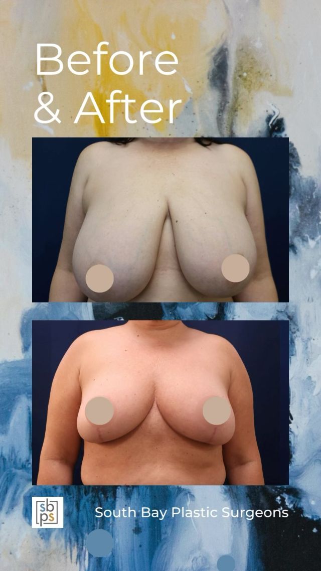 After enduring years of chronic neck and shoulder pain as a result of the size of her breasts, this 50-year old patient met with one of our board-certified plastic surgeons about breast reduction surgery. @lisa_jewell_md_plasticsurgery performed a breast reduction and removed 892g of tissue from the right breast and 600g from the left breast. She now has smaller, lifted breasts and relief of her symptoms. Liposuction of the bra line was also performed in order to give the patient a smoother contour.⁠
⁠
This patient is thrilled with her result!⁠
⁠
Unedited photos linked in bio. All photos posted with patient permission.⁠
⁠
Call us at 310-784-0644 to schedule a consultation!⁠
⁠
#southbayplasticsurgeons #sbps #breastreduction ⁠
⁠