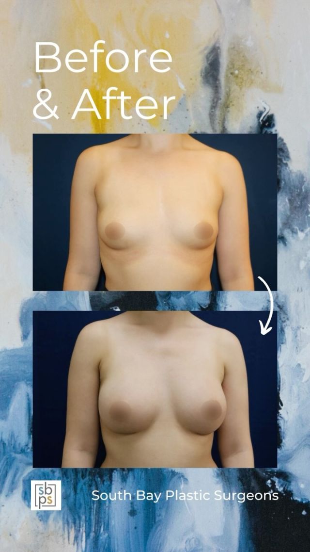 This 32-year-old woman wanted a fuller and more round breast shape. @drnewmanplasticsurgery performed a breast augmentation with @sientrainc 285cc moderate profile silicone implants placed under the muscle and through the inframammary (IMF/under the breast) incision. ⁠
⁠
This patient loves her result!⁠
⁠
Unedited photos at the link in bio. All photos posted with patient permission.⁠
⁠
Click the link in our bio or call us at 310-784-0644 to schedule a consultation today!⁠
⁠
#southbayplasticsurgeons #sbps #breastaugmentation⁠
⁠