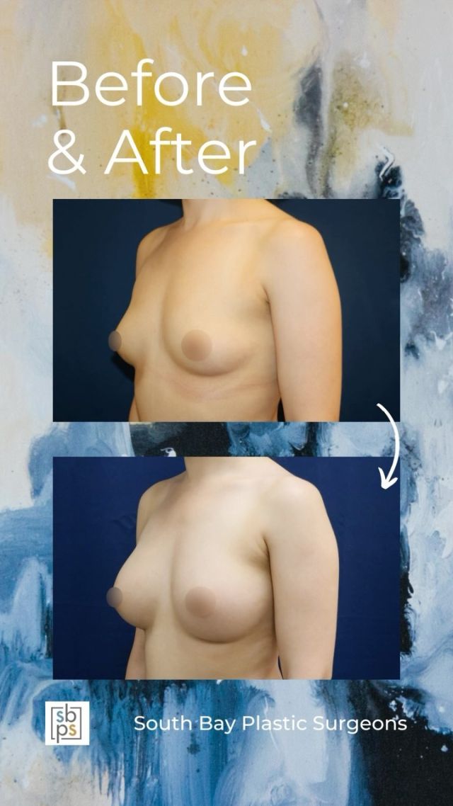 This 32-year-old woman wanted a fuller and more round breast shape. @drnewmanplasticsurgery performed a breast augmentation with @sientrainc 285cc moderate profile silicone implants placed under the muscle and through the inframammary (IMF/under the breast) incision. ⁠
⁠
This patient loves her result!⁠
⁠
Unedited photos at the link in bio. All photos posted with patient permission.⁠
⁠
Click the link in our bio or call us at 310-784-0644 to schedule a consultation today!⁠
⁠
#southbayplasticsurgeons #sbps #breastaugmentation