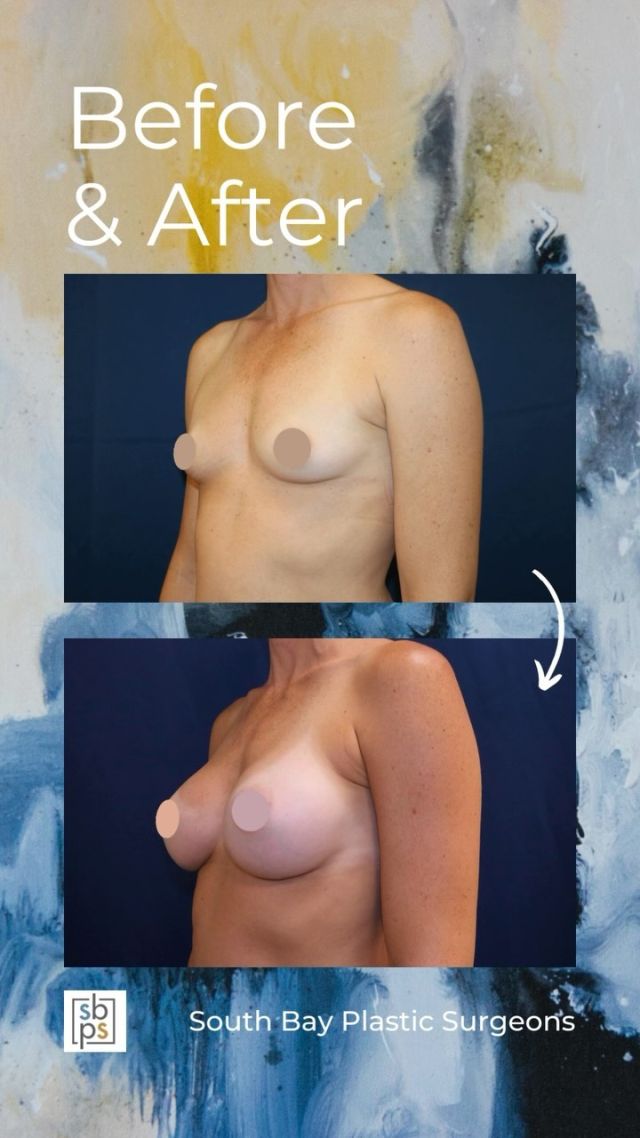 This 40-year-old woman wanted a fuller and more round breast shape. @drnewmanplasticsurgery performed a breast augmentation and placed a @sientrainc 255c moderate profile silicone implant on the right side and 235cc moderate profile on the left. Both implants were placed under the muscle and through the inframammary (IMF/under the breast) incision. ⁠
⁠
This patient loves her result!⁠
⁠
Unedited photos at the link in bio. All photos posted with patient permission.⁠
⁠
Click the link in our bio or call us at 310-784-0644 to schedule a consultation today!⁠
⁠
#southbayplasticsurgeons #sbps #breastaugmentation⁠
⁠