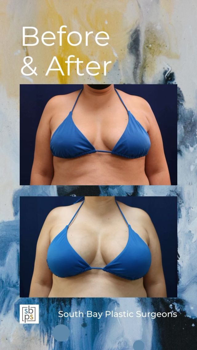 This 40-year-old woman wanted a fuller and more round breast shape. @lisa_jewell_md_plasticsurgery performed a breast augmentation with @sientrainc 440cc high profile silicone implants placed under the muscle and through the inframammary (IMF/under the breast) incision. ⁠
⁠
This patient loves how she looks in a bikini!⁠
⁠
Unedited photos at the link in bio. All photos posted with patient permission.⁠
⁠
Click the link in our bio or call us at 310-784-0644 to schedule a consultation today!⁠
⁠
#southbayplasticsurgeons #sbps #breastaugmentation