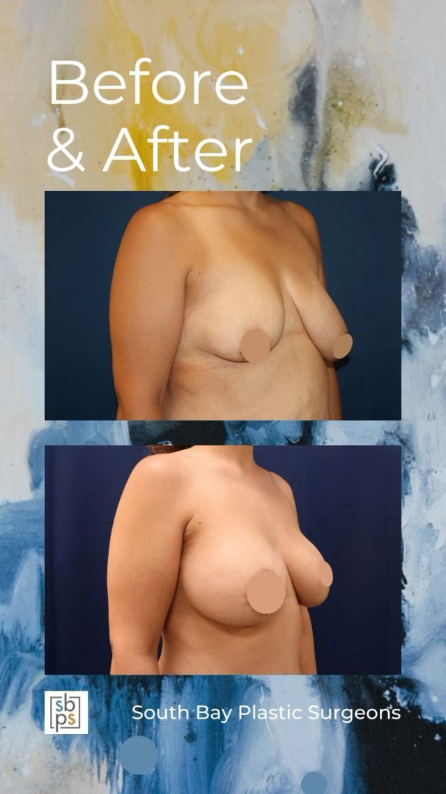 After undergoing weight loss surgery, this 45-year-old woman was unhappy with the size and shape of her breasts. @drnewmanplasticsurgery performed a breast augmentation and lift in order to add fullness, change the position of her breasts, and correct asymmetry. He placed a @sientrainc 440c high profile silicone implant on the right side and 255cc moderate profile on the left. Both implants were placed under the muscle. ⁠
⁠
This patient loves her result!⁠
⁠
Unedited photos at the link in bio. All photos posted with patient permission.⁠
⁠
Click the link in our bio or call us at 310-784-0644 to schedule a consultation today!⁠
⁠
#southbayplasticsurgeons #sbps #breastaugmentation