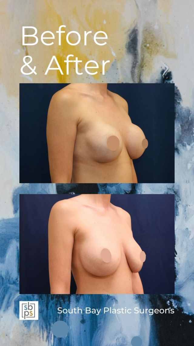 While most implants last many years, over time, patients may experience changes in their breasts. When it comes to secondary breast surgery, our board-certified plastic surgeons work with patients to create a customized surgical plan that meets their goals.⁠
⁠
This patient had breast implants placed twenty-two years ago and she developed a capsular contracture. @drnewmanplasticsurgery removed and replaced her breast implants, converted her from saline to silicone, and placed the implants above the muscle and through the inframammary (IMF/under the breast) incision. This resulted in a more natural breast shape!⁠
⁠
Are you interested in primary or secondary breast surgery? Click the link in bio or call us at 310-784-0644.⁠
⁠
#southbayplasticsurgeons #sbps #breastimplantremoval