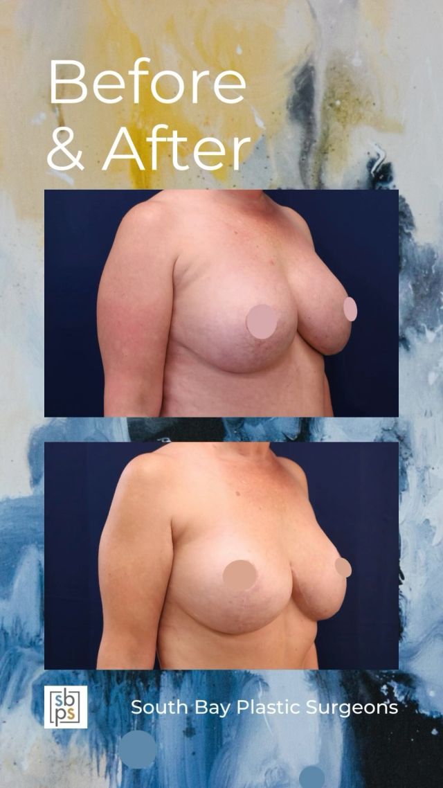 While most breast implants last many years, over time, patients may experience changes in their breasts. When it comes to secondary breast surgery, our board-certified plastic surgeons work with our patients to create a customized surgical plan that meets their goals.⁠
⁠
This patient had breast implants placed thirteen years ago and she was unhappy with the size. @drwhitneyburrell removed and replaced her breast implants, used two different sizes to account for asymmetry, downsized, and performed a breast lift using the anchor incision. We exceeded this patient’s expectations and she loves her result!⁠
⁠
Are you interested in primary or secondary breast surgery? Click the link in bio or call us at 310-784-0644.⁠
⁠
#southbayplasticsurgeons #sbps #breastimplantremoval