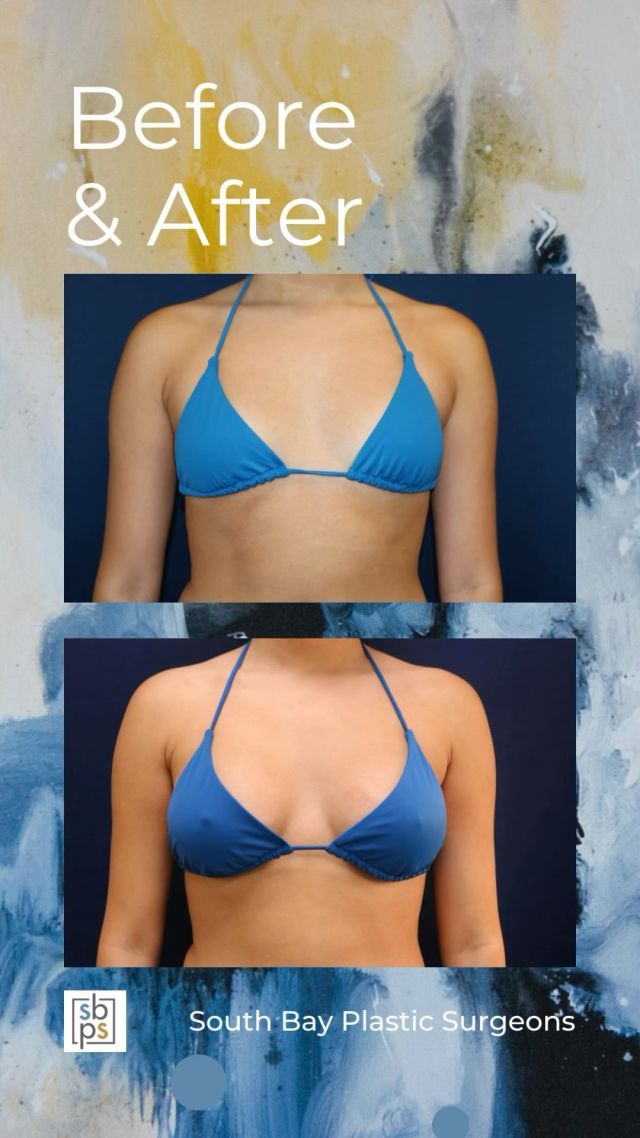 This 20-year-old woman wanted a fuller and more round breast shape. @drnewmanplasticsurgery performed a breast augmentation with saline implants placed under the muscle and through the inframammary (IMF/under the breast) incision. The right breast implant was filled to 350cc and the left was filled to 360cc to correct asymmetry @natrellebreastaugmentation. ⁠
⁠
This patient loves how she looks in a bikini!⁠
⁠
Unedited photos at the link in bio. All photos posted with patient permission.⁠
⁠
Click the link in our bio or call us at 310-784-0644 to schedule a consultation today!⁠
⁠
#southbayplasticsurgeons #sbps #breastaugmentation