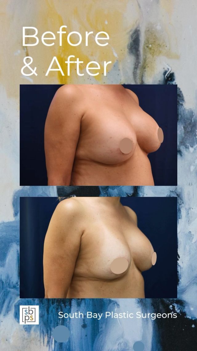 Patients may choose to revisit their implants for a variety of reasons. For this patient, a mammogram and ultrasound revealed she had a rupture. She was also looking to go down in size and change the shape.⁠
⁠
@dr.j_rendon removed her old implants and replaced them with 305cc moderate profile implants on both sides @sientrainc. In order to keep the skin from stretching over time, Dr. Rendon also performed a breast lift and placed Galaflex mesh to create an internal bra @galaflexbybd ⁠
⁠
Are you interested in secondary breast surgery? Click the link in bio or call us at 310-784-0644 to schedule today!⁠
⁠
#southbayplasticsurgeons #sbps #secondarybreastsurgery