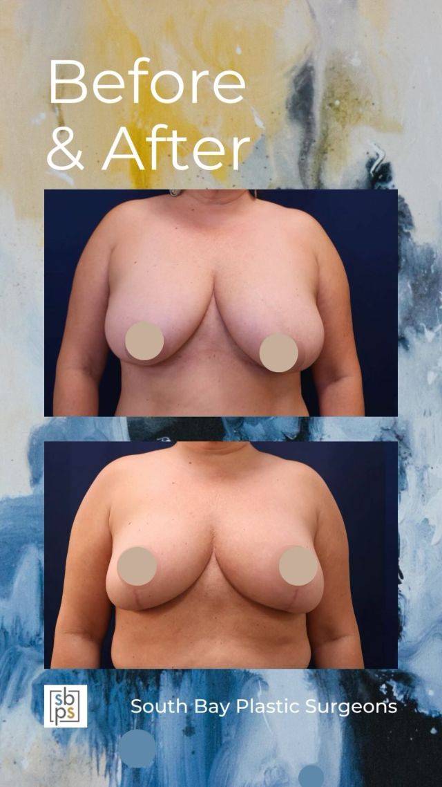 After enduring years of chronic neck and shoulder pain as a result of the size of her breasts, this 54-year old patient met with one of our board-certified plastic surgeons about breast reduction surgery. @lisa_jewell_md_plasticsurgery performed a breast reduction and removed 316g of tissue from the right breast and 364g from the left breast. She now has smaller, lifted breasts and relief of her symptoms. Liposuction of the bra line was also performed in order to give the patient a smoother contour.⁠
⁠
This patient is thrilled with her result!⁠
⁠
Unedited photos linked in bio. All photos posted with patient permission.⁠
⁠
Call us at 310-784-0644 to schedule a consultation!⁠
⁠
#southbayplasticsurgeons #sbps #breastreduction