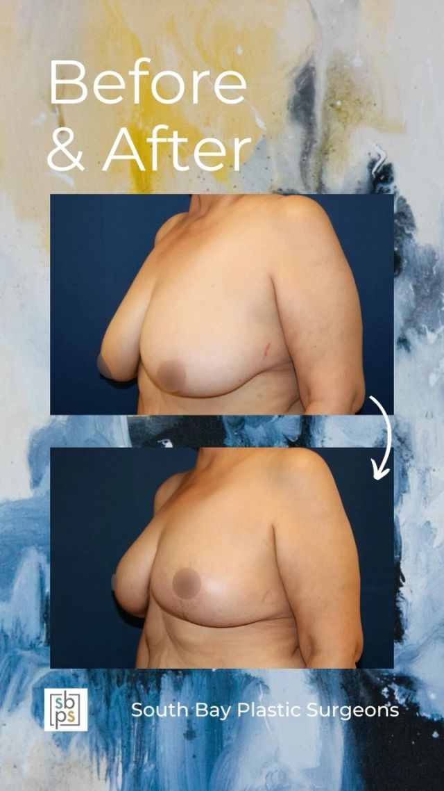 After being diagnosed with breast cancer, this 53-year old patient met with one of our board-certified plastic surgeons about reconstructive surgery. After undergoing a lumpectomy to remove the cancer and obtain clean margins, @drliangplasticsurgeon performed an oncoplastic reduction.⁠
⁠
This patient is thrilled with her results!⁠
⁠
Unedited photos linked in bio. All photos posted with patient permission.⁠
⁠
Call us at 310-784-0644 to schedule a consultation!⁠
⁠
#southbayplasticsurgeons #sbps #breastreconstruction