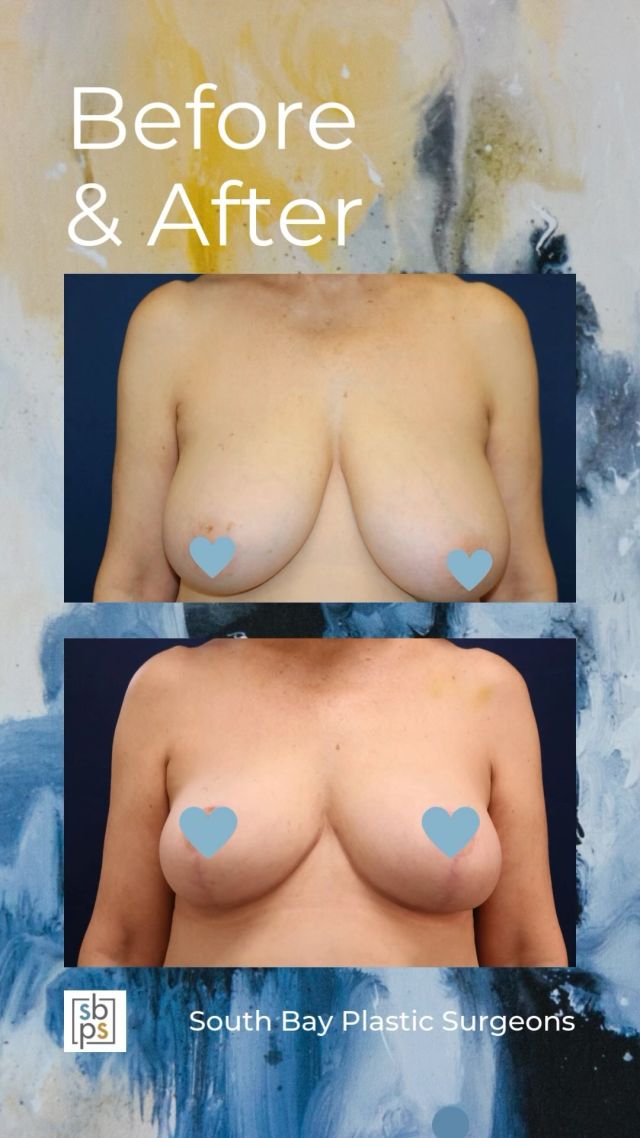 ✨ Before & After: Breast Reduction Transformation✨⁠
⁠
Swipe to see the life-changing results of a **breast reduction** surgery! 🌸 This patient wanted relief from the physical discomfort of overly large breasts—neck pain, back pain, and posture issues—and now she’s not only feeling more comfortable, but also more confident with her beautifully balanced, natural shape. 💕⁠
⁠
Breast reduction doesn’t just change your appearance, it can improve your quality of life by alleviating pain and restoring balance to your body. 🙌⁠
⁠
If you’re ready to experience the benefits of a breast reduction, call us at 310-784-0644 to schedule a consultation or visit www.plasticsurgerysource.com for more information!⁠
⁠
#BreastReduction #BeforeAndAfter #LifeChangingResults #SouthBayPlasticSurgeons #TorrancePlasticSurgery #ConfidenceBoost #BodyTransformation #FeelYourBest #ComfortAndConfidence⁠
⁠