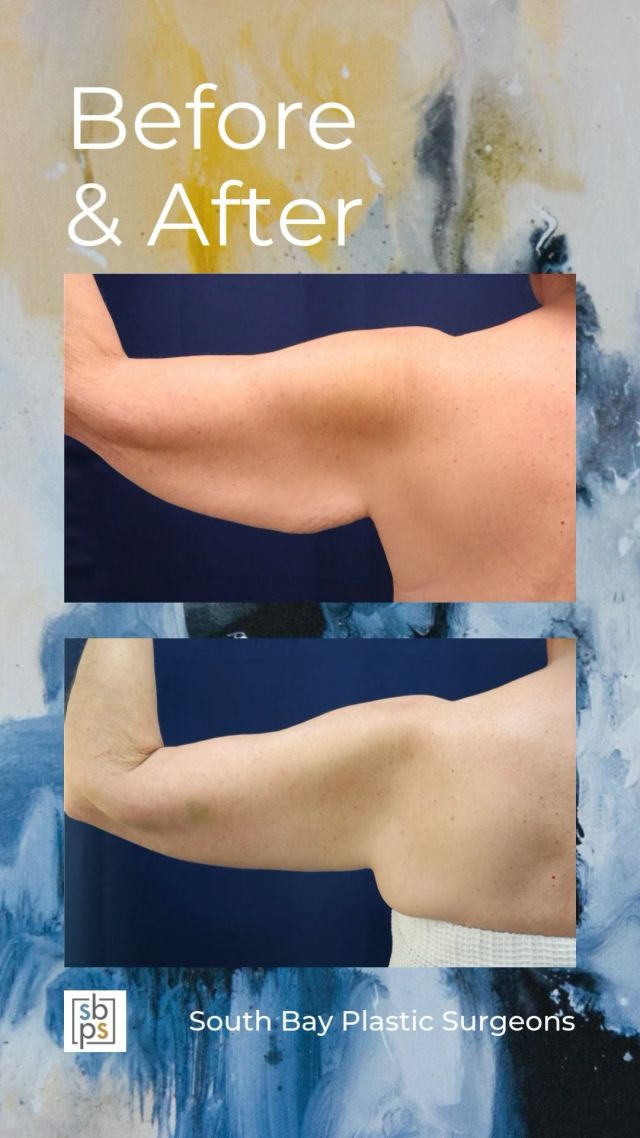 An arm lift, also known as a brachioplasty, reduces excess skin and fat and reshapes the arm resulting in a smoother appearance. There are several versions of this procedure depending on the amount and location of the loose skin. Our board-certified plastic surgeons work with patients to create a customized surgical plan based on their goals.⁠
⁠
For this patient, @drliangplasticsurgeon performed liposuction and an avulsion brachioplasty to address her concerns. This combination of procedures dramatically improved her contour!⁠
⁠
Are you interested in an arm lift? Click the link in bio or call us at 310-784-0644 to schedule today!⁠
⁠
#southbayplasticsurgeons #sbps #brachioplasty⁠