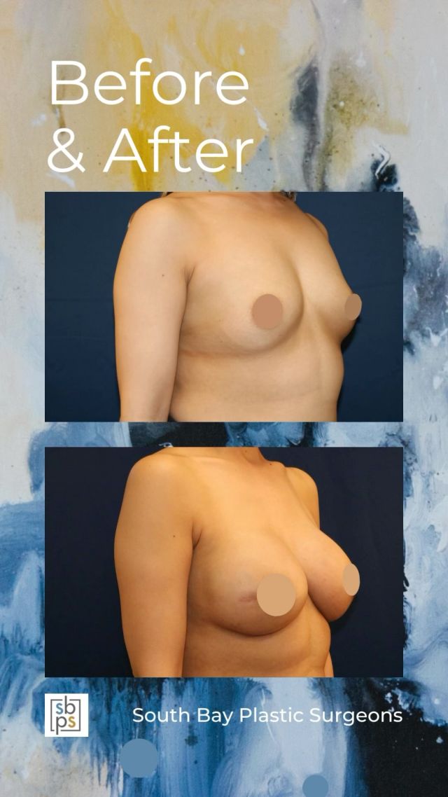 After being diagnosed with breast cancer, this 42-year old patient underwent a double mastectomy to remove the cancer and obtain clean margins. @drnewmanplasticsurgery then performed staged breast reconstruction with expanders followed by the placement of implants and fat grafting using the @puregraft system. ⁠
⁠
This patient is thrilled with her results!⁠
⁠
Unedited photos linked in bio. All photos posted with patient permission.⁠
⁠
Call us at 310-784-0644 to schedule a consultation today!⁠
⁠
#southbayplasticsurgeons #sbps #breastreconstruction